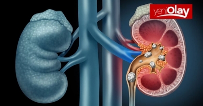 BÖBREK TAŞI VE BÖBREK TAŞI TEDAVİSİ