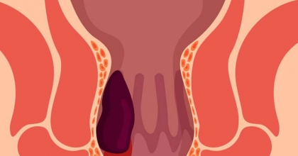 Hemoroid Nedir? Tedavisi Mümkün mü?