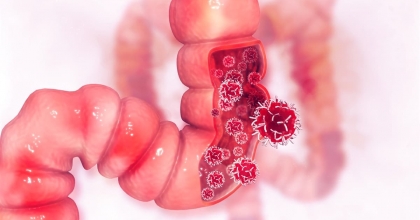 Kolon Kanseri Neden Olur?