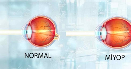 Miyop Nedir, Nasıl Tedavi Edilir?