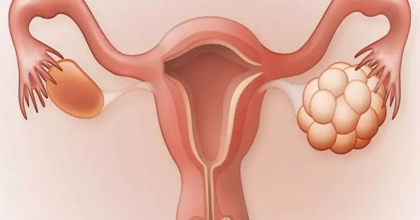 Polikistik Over Nedir? Tedavisi Mümkün mü?