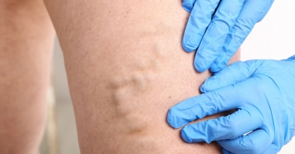 Varis Nedir? Nasıl Tedavi Edilir?