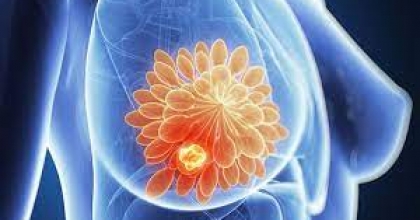 Meme Kanseri İçin Alınabilecek 5 Yöntem