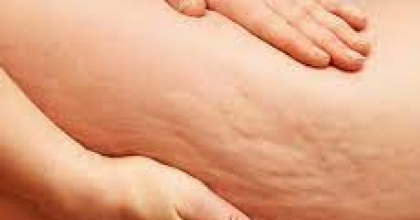 Selülit Oluşumunu Engellemek İçin Yapılabilecek Egzersiz Türleri