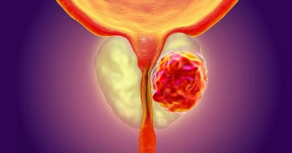 Prostat Kanseri Nedir? Tedavisi Hakkında