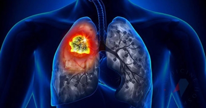 Akciğer Kanseri Nasıl Gelişir? Tedavisi Mümkün mü?