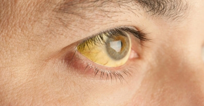 Gözlerdeki Sarı / Kahverengi Beneklerin Sebebi Ne?