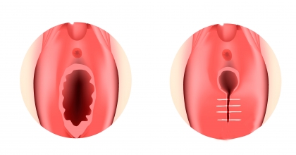 Kızlık Zarı Dikim İşlemleri