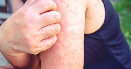 Kızamık Hastalığı