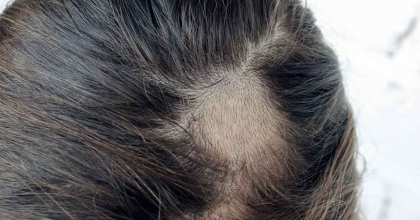 Saçkıran Hastalığı Nedir?