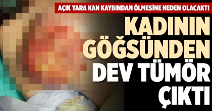 KADININ GÖĞSÜNDEN DEV TÜMÖR ÇIKTI