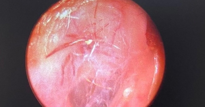 KULAĞINDAN CANLI ÖRÜMCEK ÇIKTI