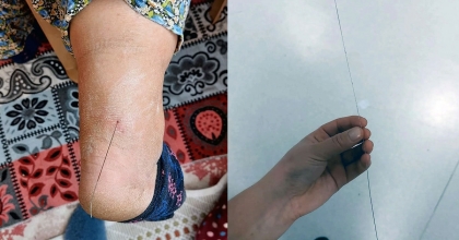 AYAK TOPUĞUNDAN 37 SANTİM TEL ÇIKTI