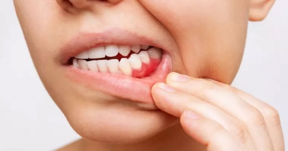 AĞIZDAKİ DEĞİŞİKLİKLER DİYABETİN SİNYALİ OLABİLİR