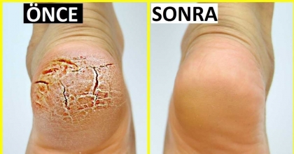 AYAKLARINIZI MAYALI SUDA BEKLETİRSENİZ…