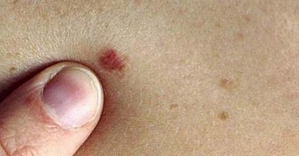 UZMANINDAN CİLT KANSERİ UYARISI