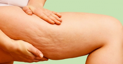 KADINLARIN EN BÜYÜK SORUNU LİPÖDEM