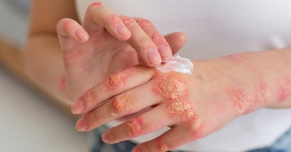 SEDEF HASTALIĞI BULAŞICI DEĞİL