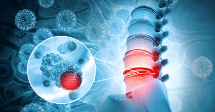 BEYİN VE OMURGA TÜMÖRLERİNDE ERKEN TANININ ÖNEMİ