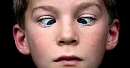 ÇOCUKLARDA ŞAŞILIĞIN ERKEN DÖNEM TEDAVİSİ BÜYÜK ÖNEM TAŞIYOR